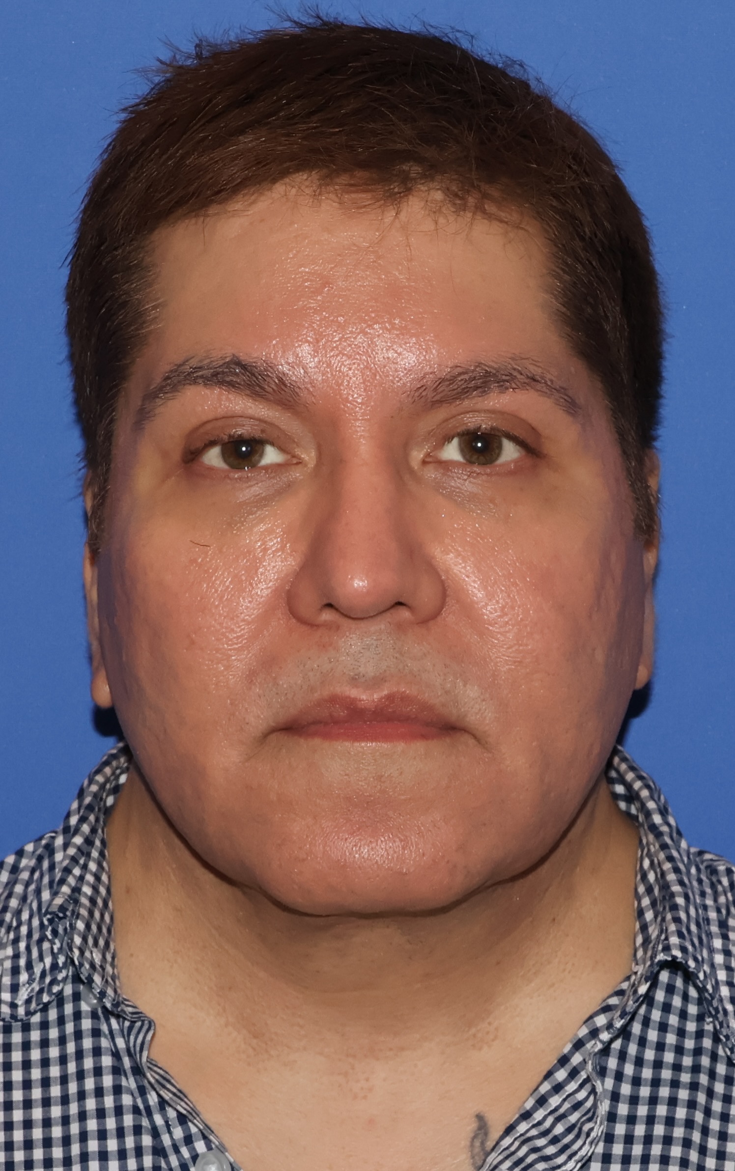 Brow Lift Patient Photo - Case 7 - after view-1