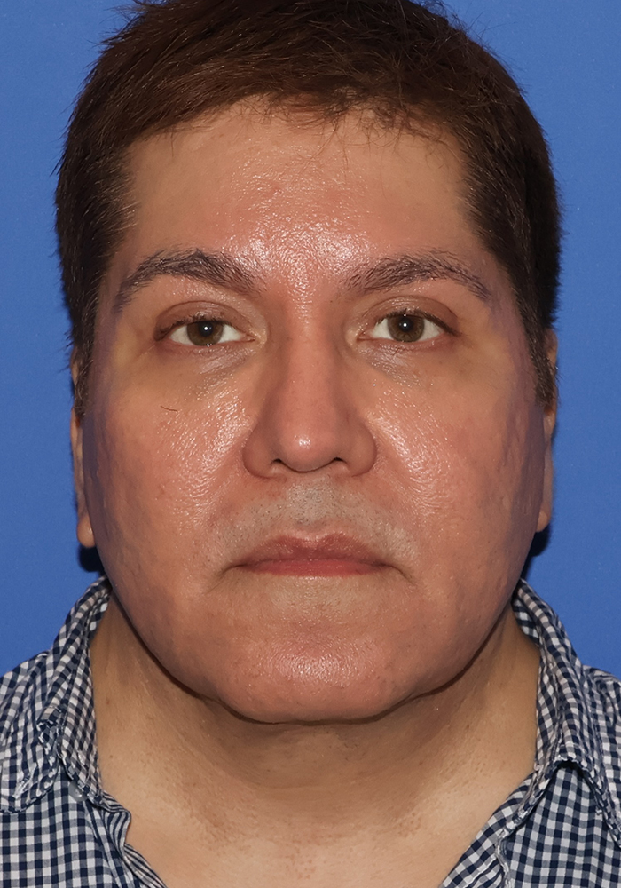 Neck Lift Patient Photo - Case 7 - after view-1