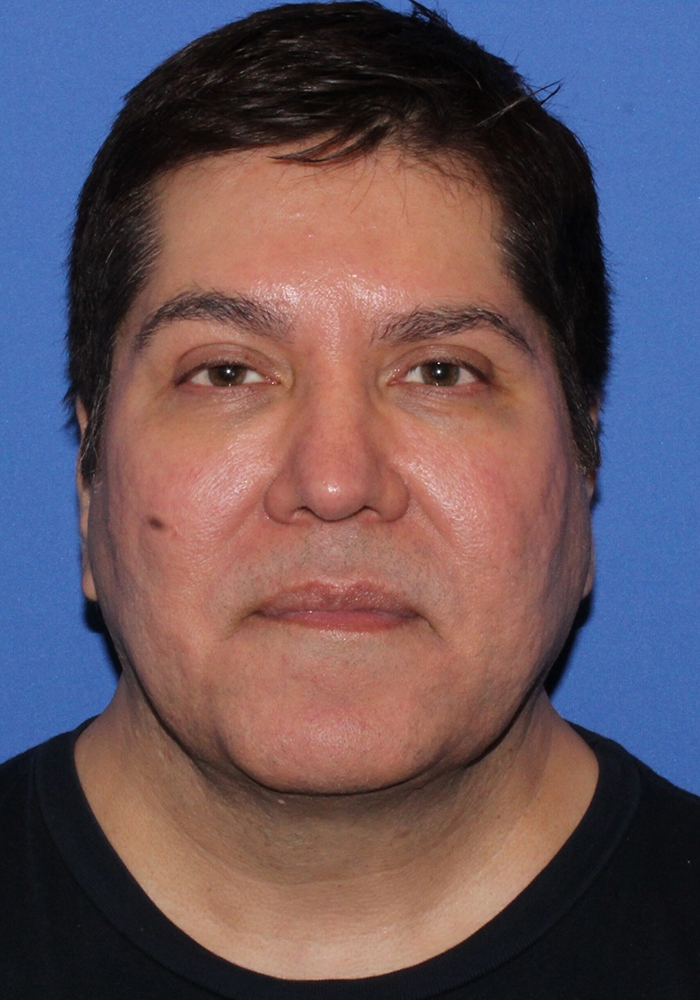 Neck Lift Patient Photo - Case 7 - before view-1