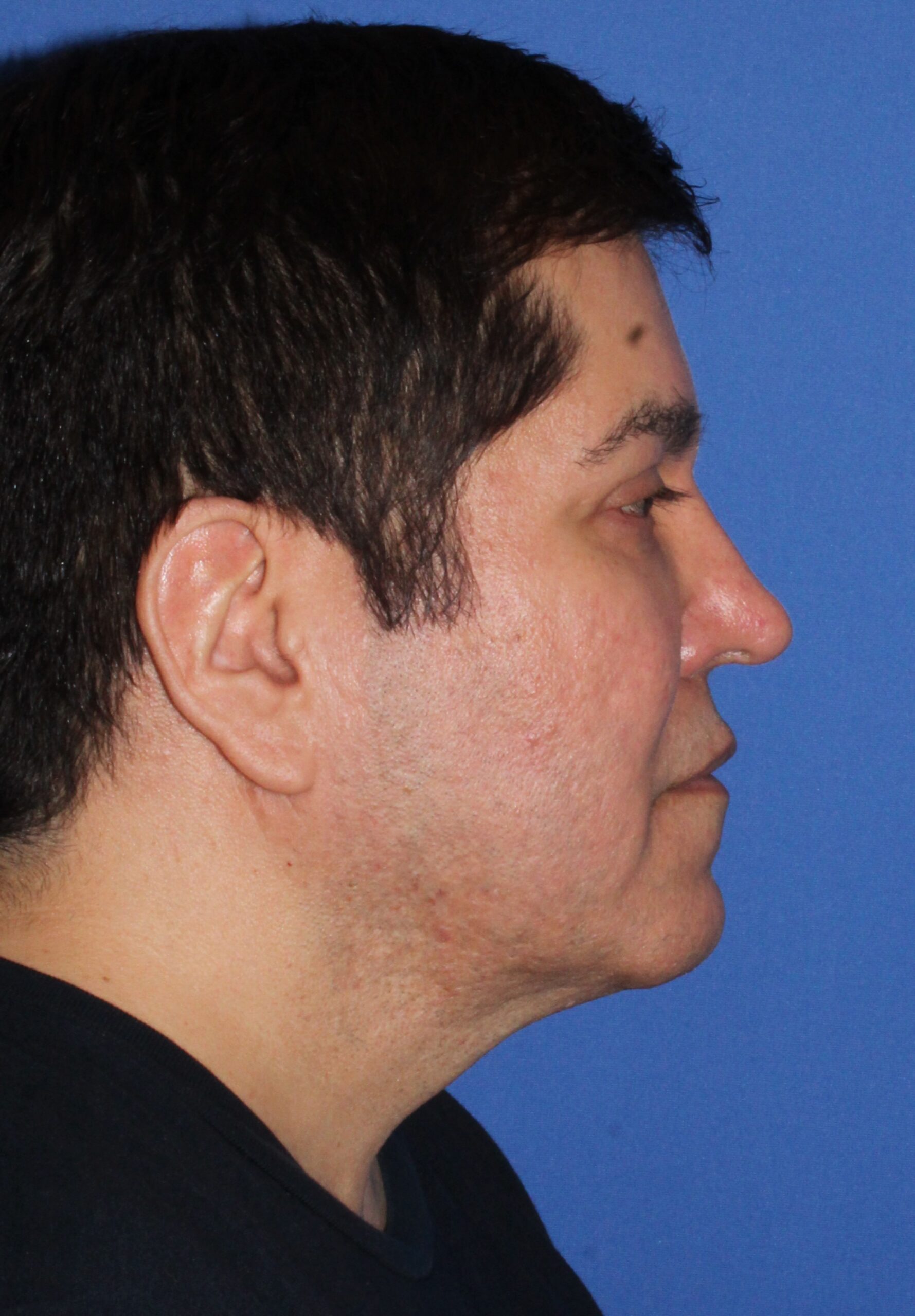Brow Lift Patient Photo - Case 7 - before view-2