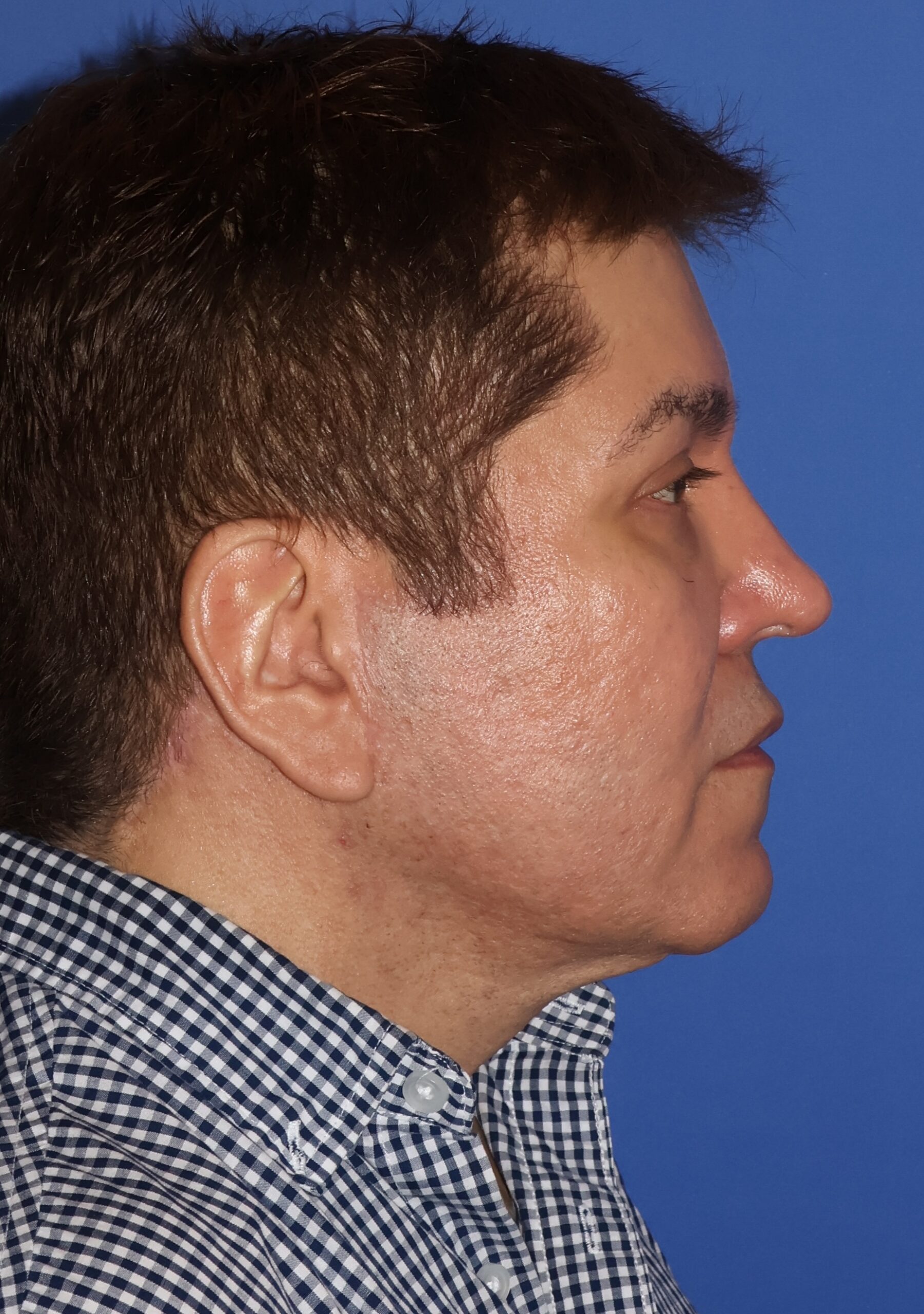 Brow Lift Patient Photo - Case 7 - after view-2