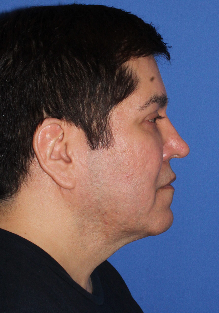 Neck Lift Patient Photo - Case 7 - before view-2