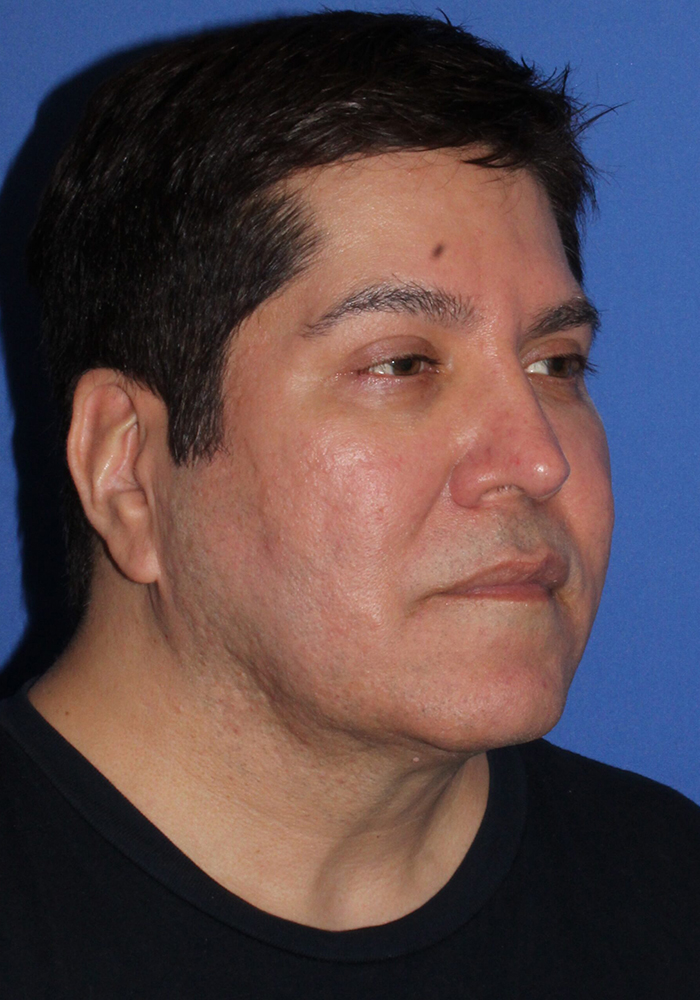 Neck Lift Patient Photo - Case 7 - before view-