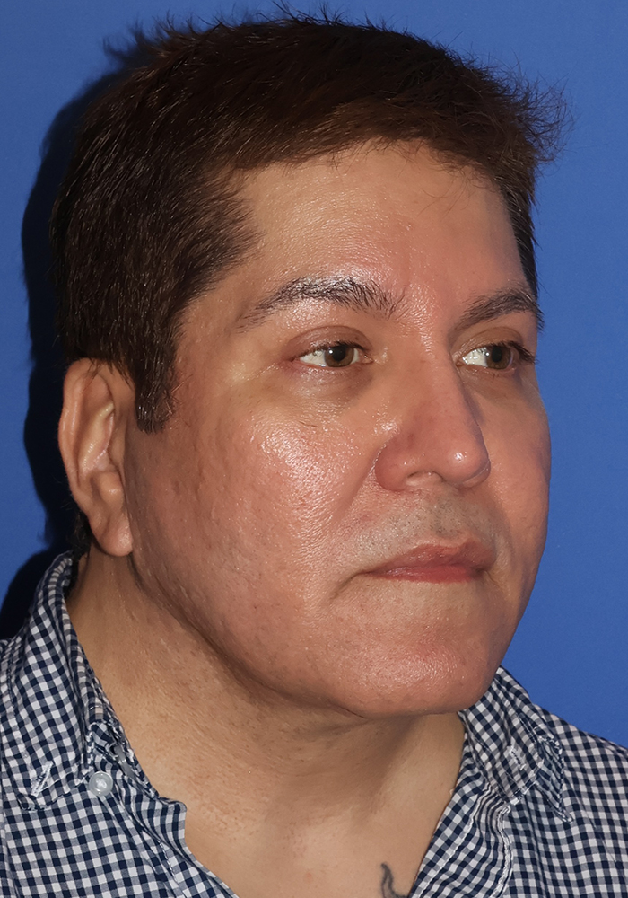 Neck Lift Patient Photo - Case 7 - after view