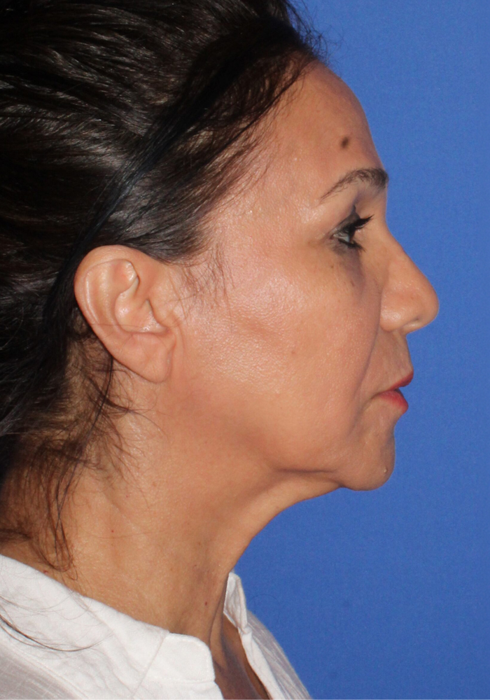 Hispanic/South American Rhinoplasty Patient Photo - Case 8 - before view-1