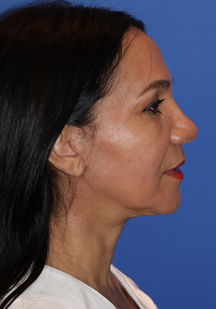Hispanic/South American Rhinoplasty Patient Photo - Case 8 - after view-1