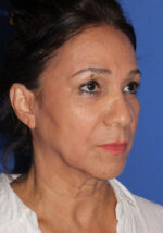 Cheek Lift - Case 8 - Before