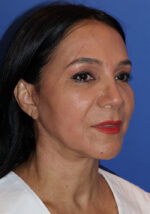 Cheek Lift - Case 8 - After