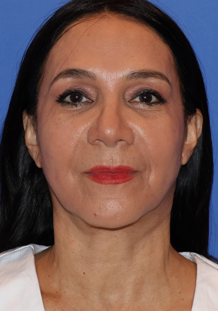 Hispanic/South American Rhinoplasty Patient Photo - Case 8 - after view-2