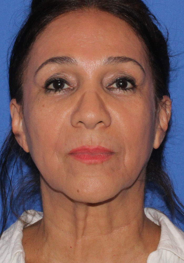Hispanic/South American Rhinoplasty Patient Photo - Case 8 - before view-2