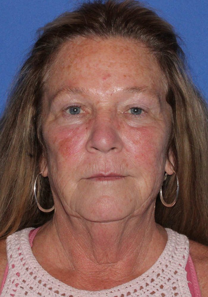 Facelift Patient Photo - Case 9 - before view-2