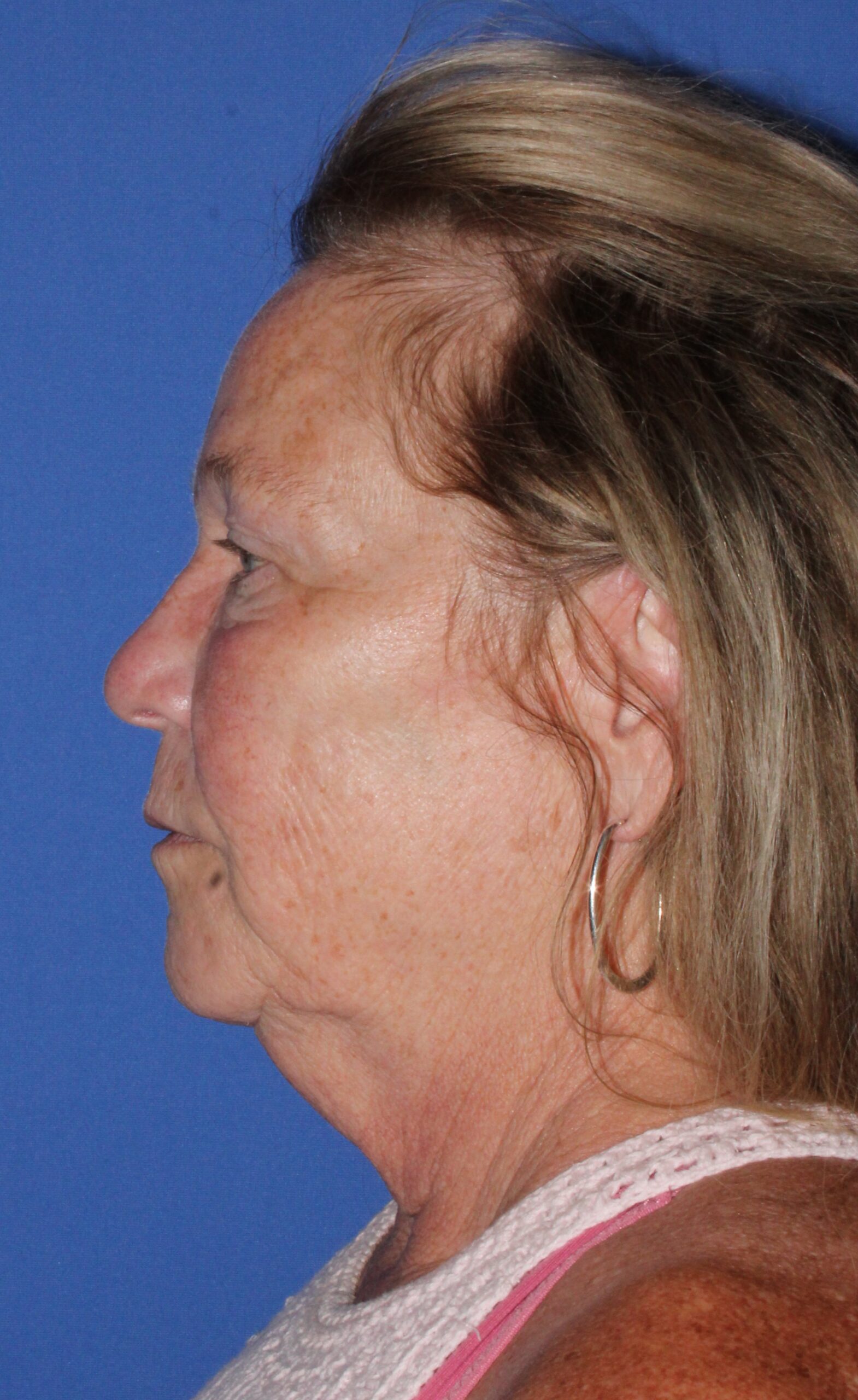 Brow Lift Patient Photo - Case 9 - before view-