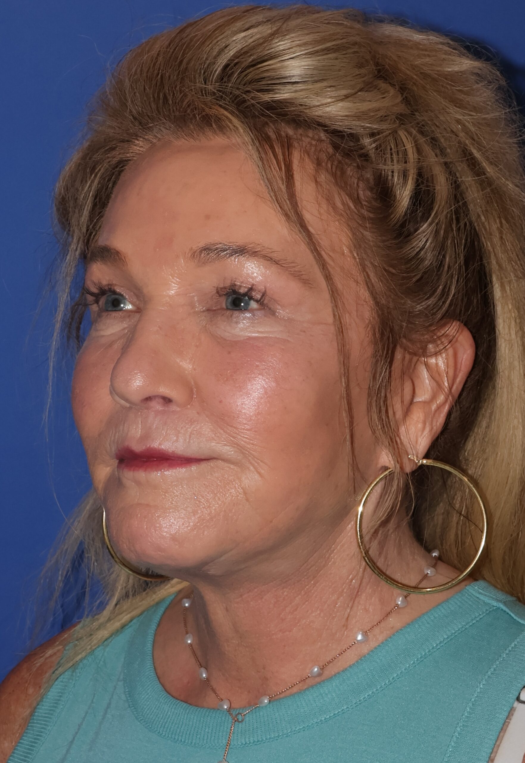 Brow Lift Patient Photo - Case 9 - after view-1