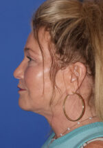 Blepharoplasty - Case 9 - After