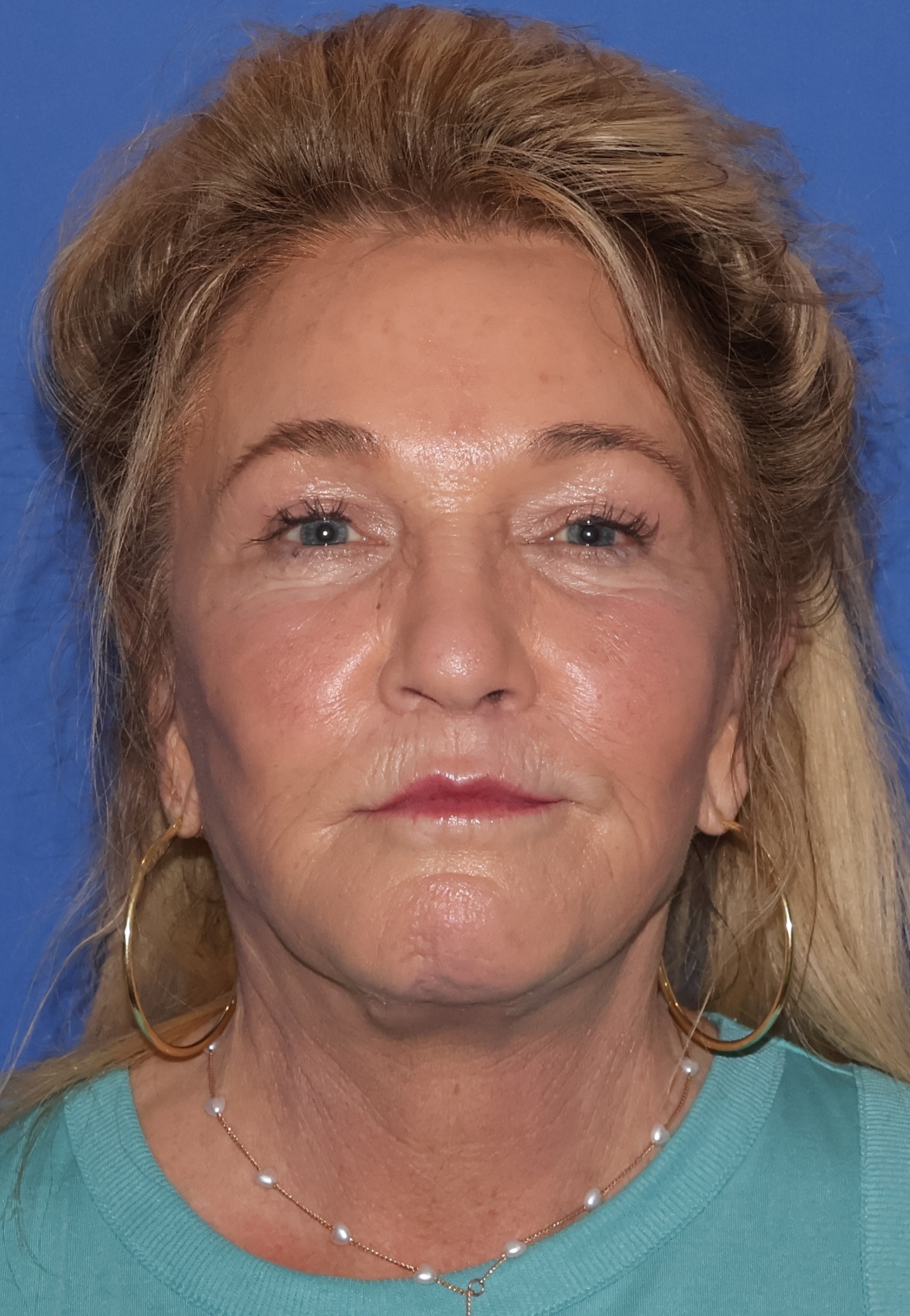 Brow Lift Patient Photo - Case 9 - after view-2