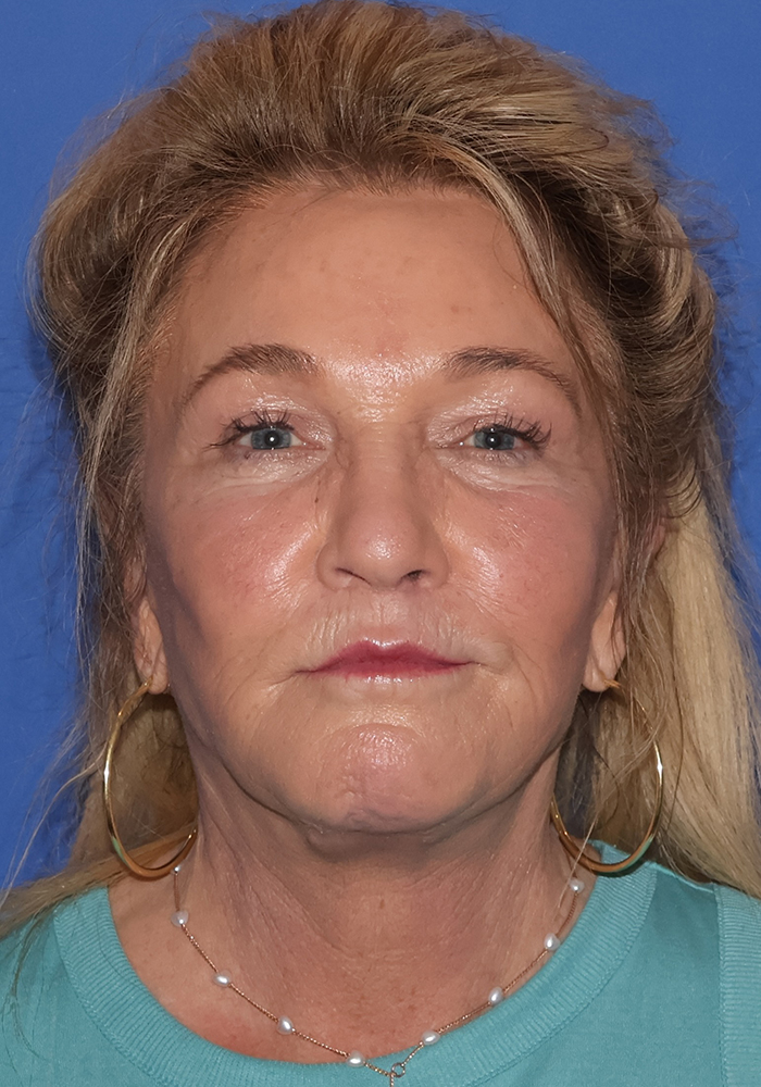 Facelift Patient Photo - Case 9 - after view-2