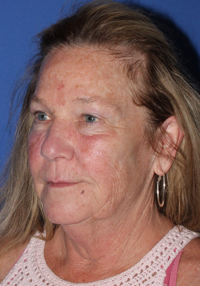 Facelift Patient Photo - Case 9 - before view-1
