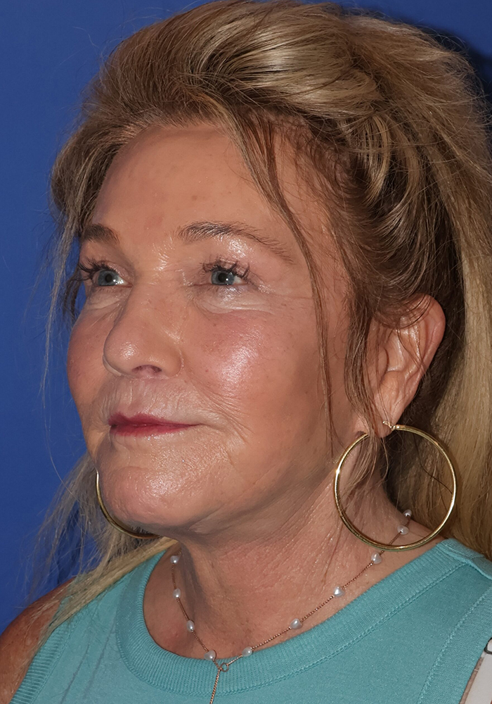 Facelift Patient Photo - Case 9 - after view-1