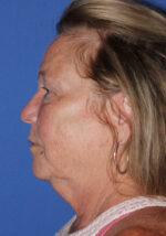 Blepharoplasty - Case 9 - Before