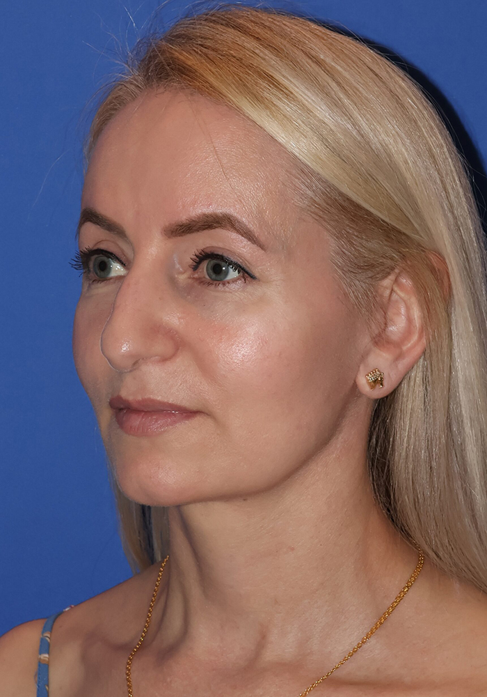 Facelift Patient Photo - Case 10a - after view-1
