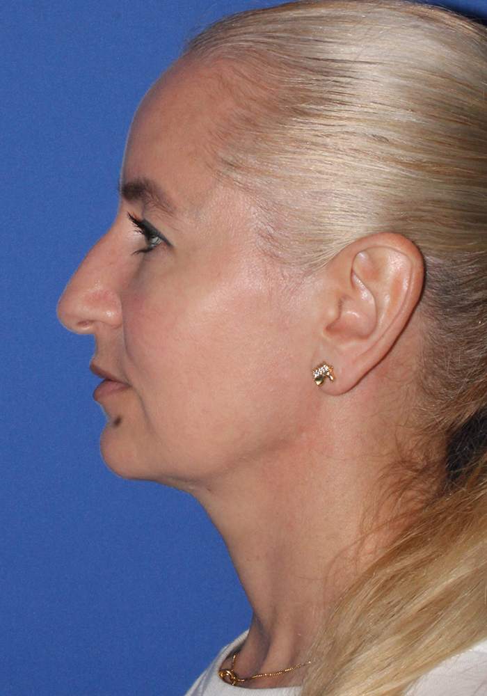 Facelift Patient Photo - Case 10a - before view-2