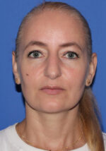 Blepharoplasty - Case 10a - Before