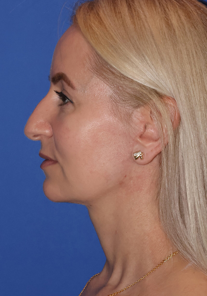 Facelift Patient Photo - Case 10a - after view-2