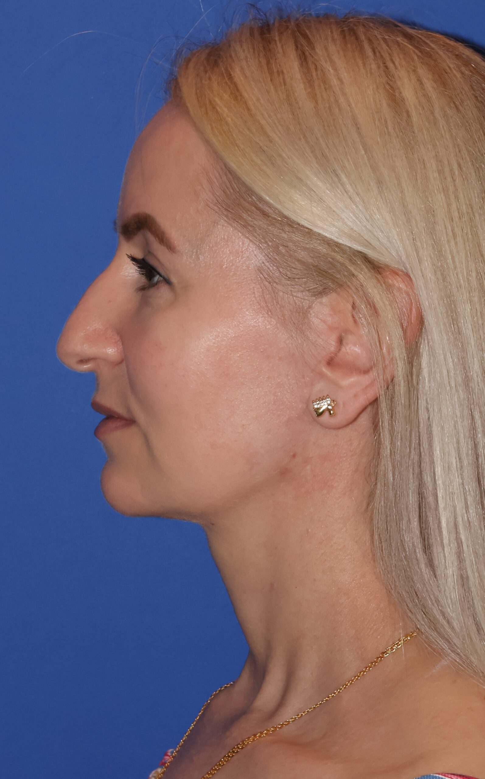 Blepharoplasty Patient Photo - Case 10a - after view-2