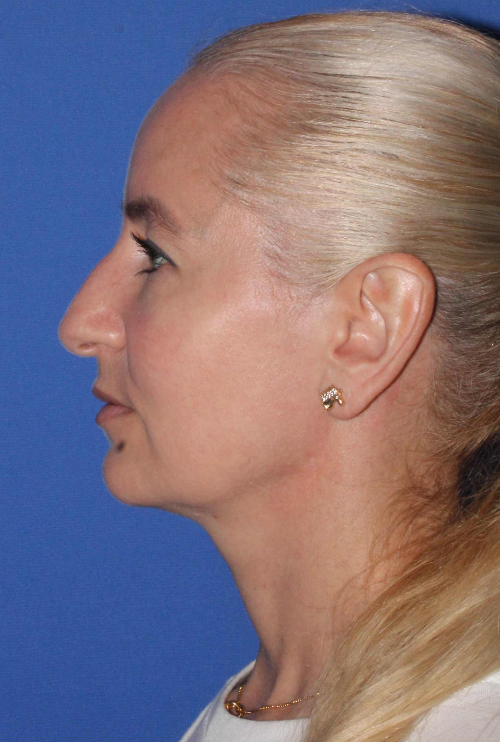 Blepharoplasty Patient Photo - Case 10a - before view-2