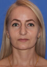 Blepharoplasty - Case 10a - After