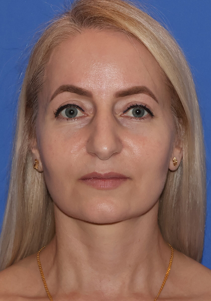 Facelift Patient Photo - Case 10a - after view