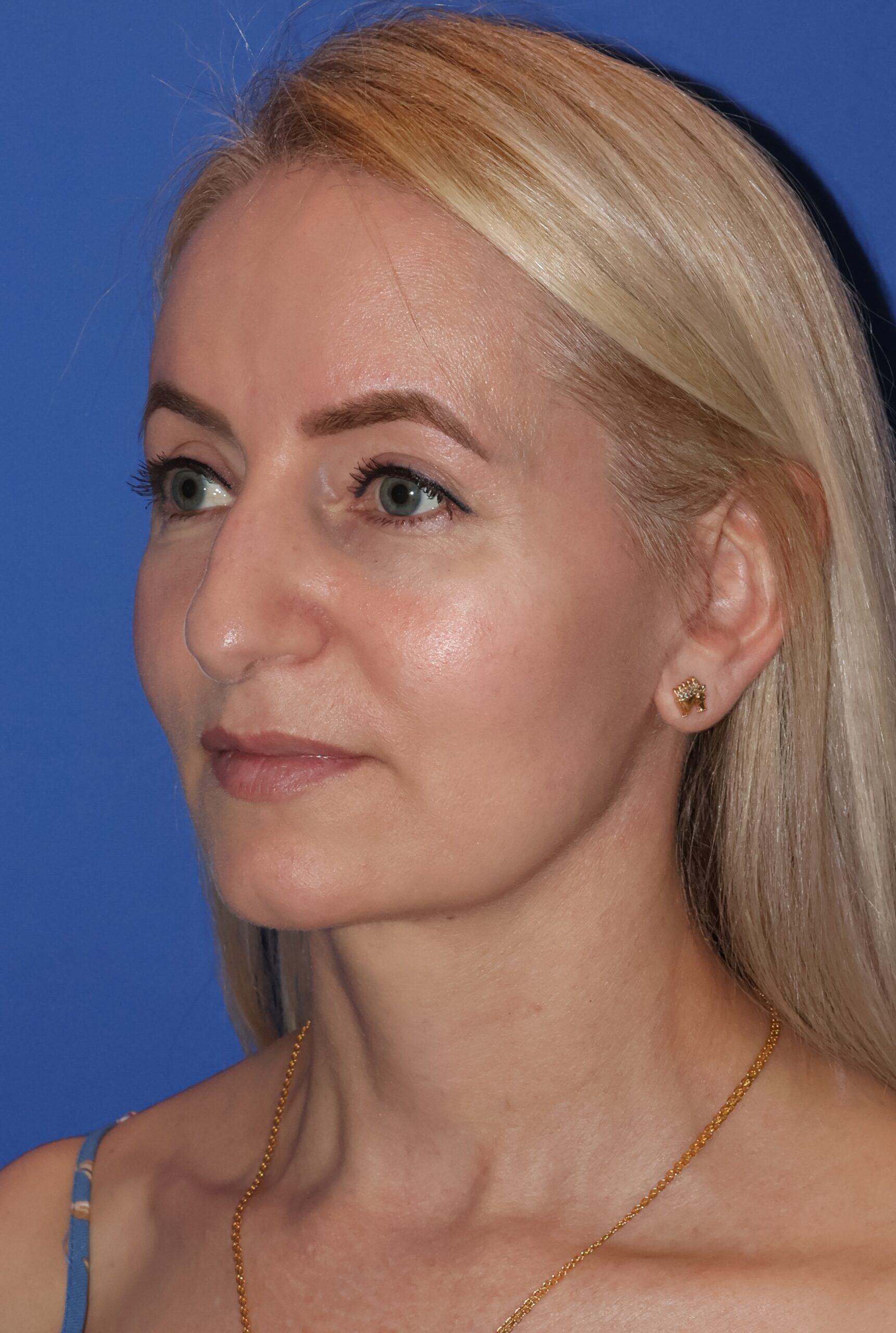 Blepharoplasty Patient Photo - Case 10a - after view-1