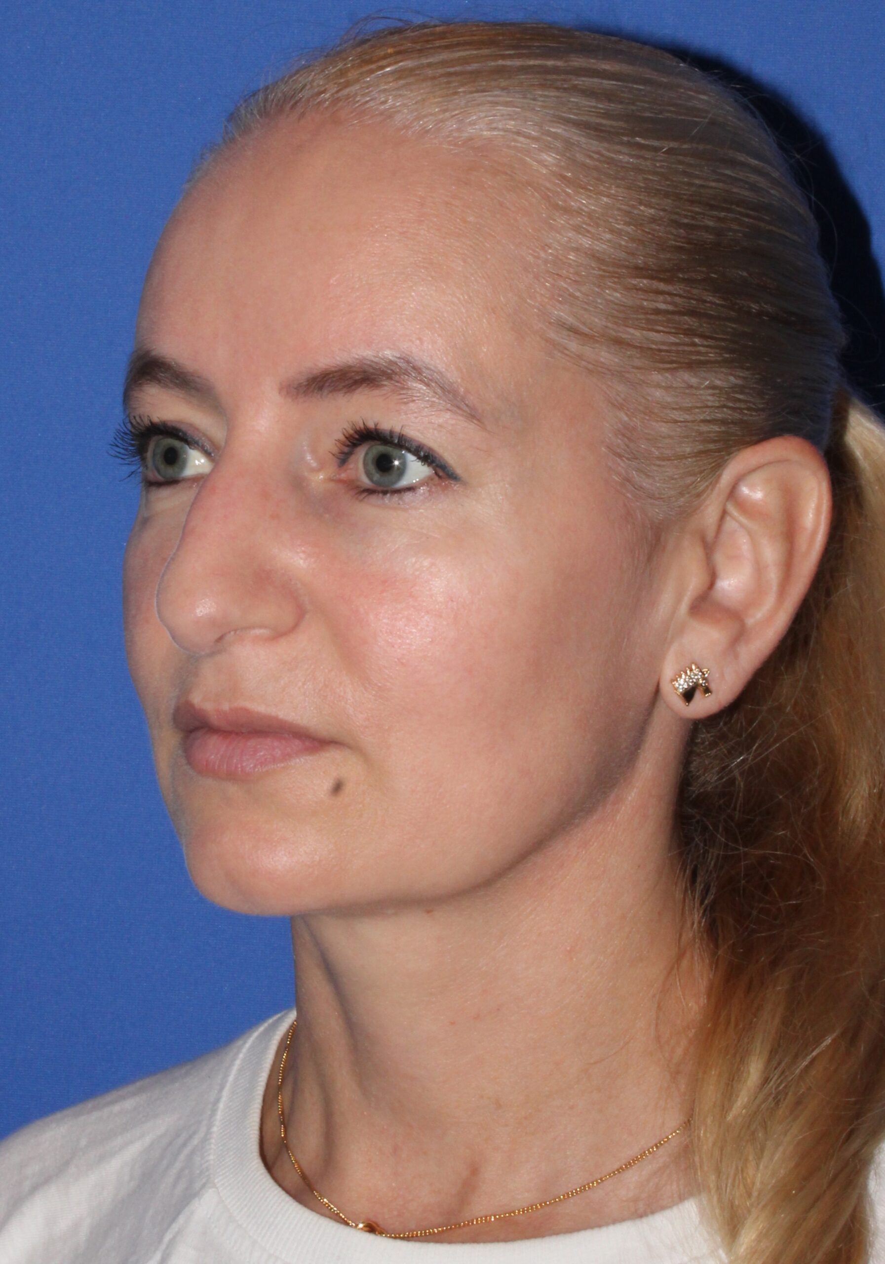 Blepharoplasty Patient Photo - Case 10a - before view-1