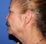 Facelift - Case 11079 - Before
