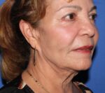 Facelift - Case 11079 - After