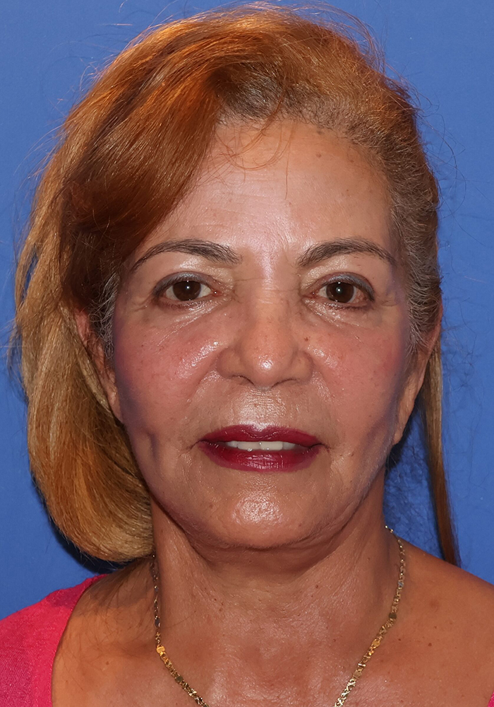 Neck Lift Patient Photo - Case 11079 - after view-1