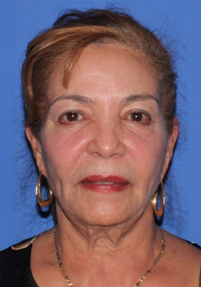 Neck Lift Patient Photo - Case 11079 - before view-1
