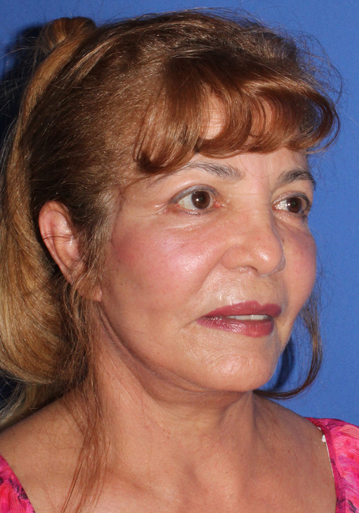 Neck Lift Patient Photo - Case 11079 - after view-2