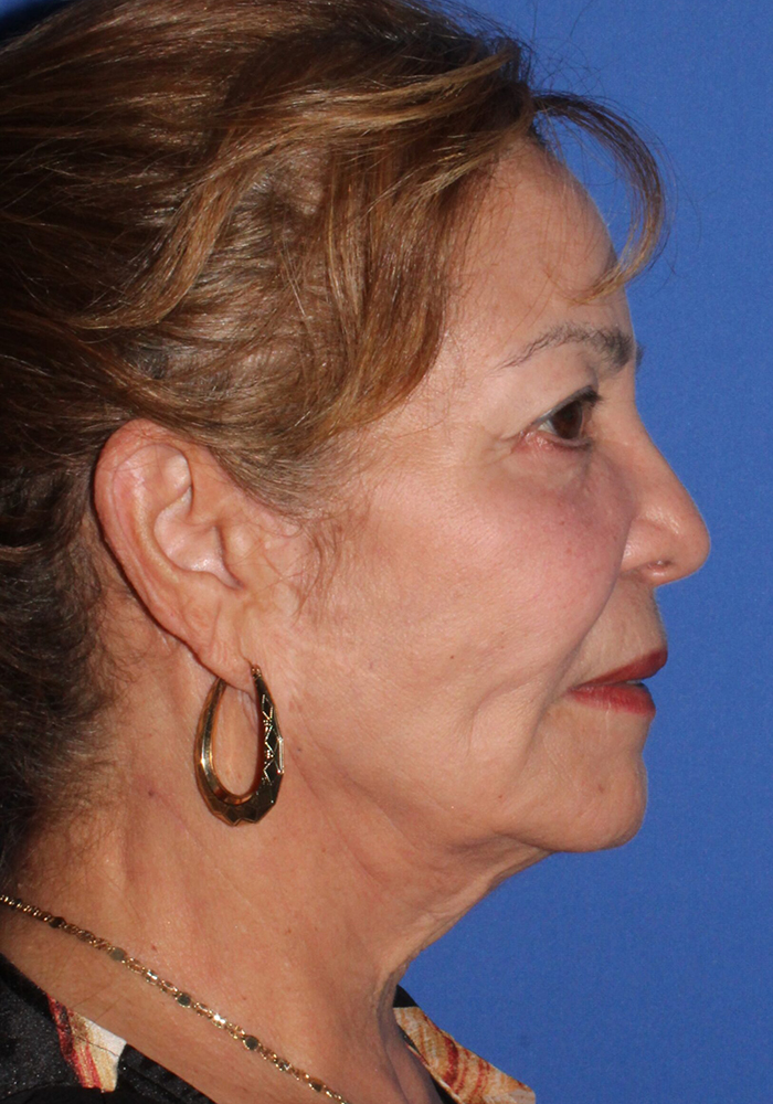 Neck Lift Patient Photo - Case 11079 - before view-3