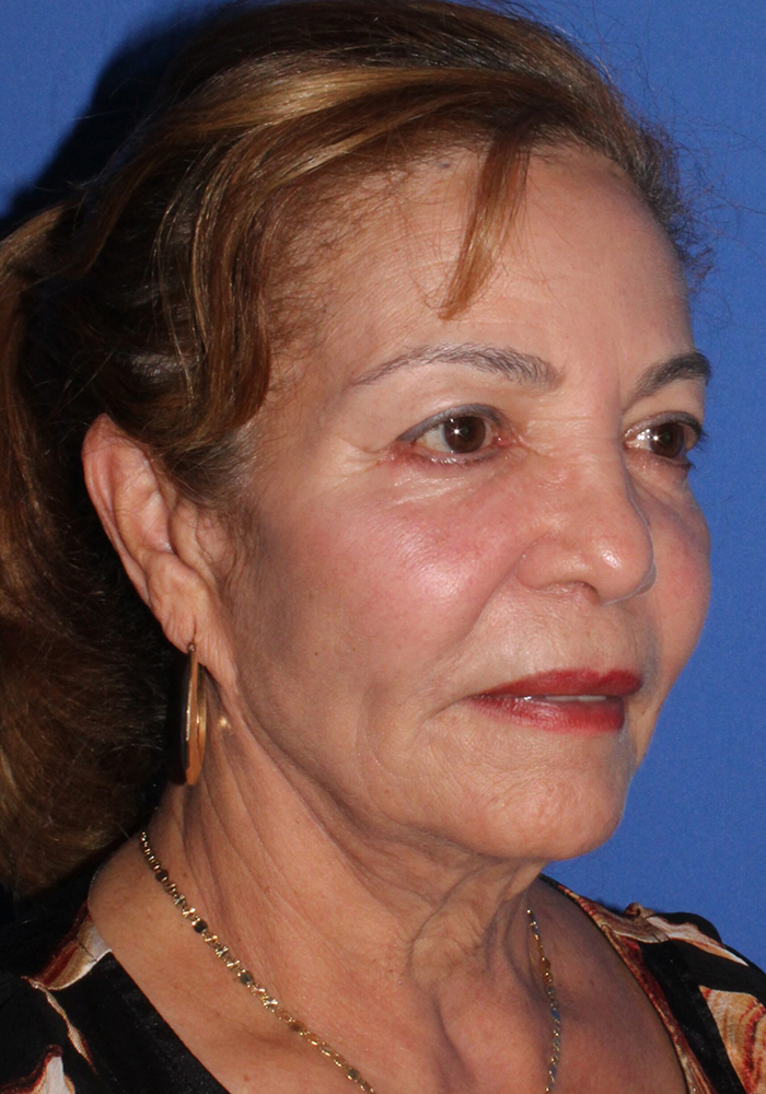 Neck Lift Patient Photo - Case 11079 - before view-2