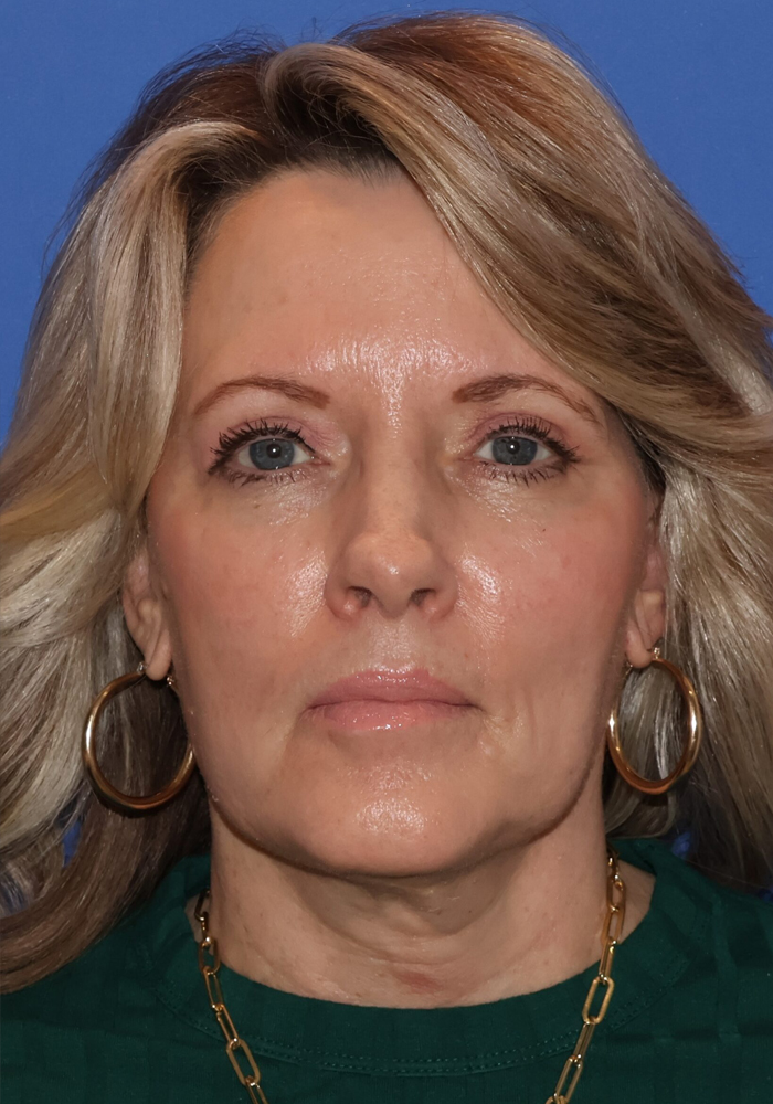 Neck Lift Patient Photo - Case 11091 - after view-1