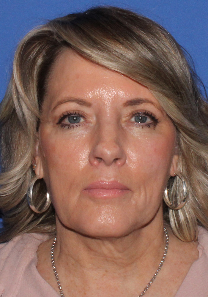 Neck Lift Patient Photo - Case 11091 - before view-1